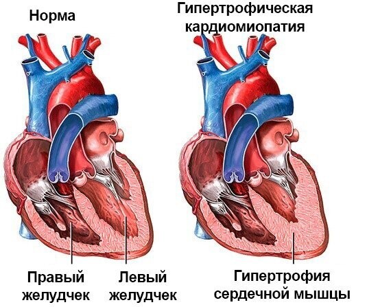 Норма и гипертрофическая кардиомиопатия (ГКМП)
